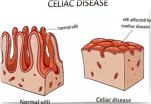 gluten intolerance