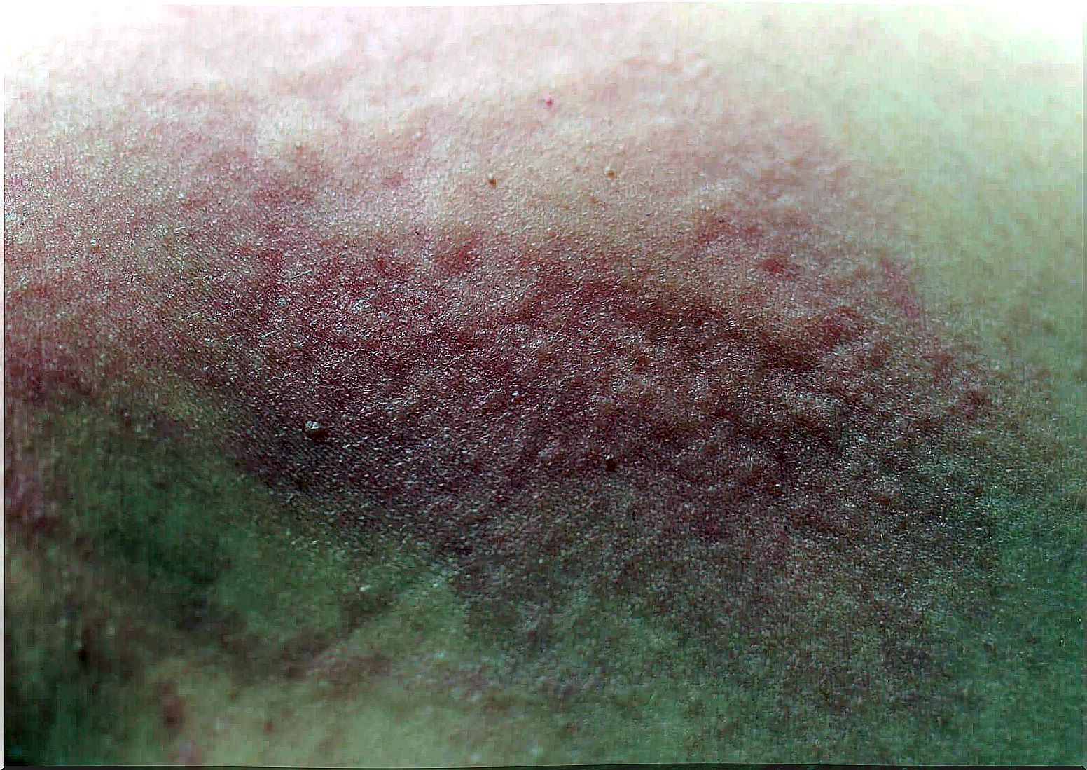 Scabies in children: symptoms, causes and treatment