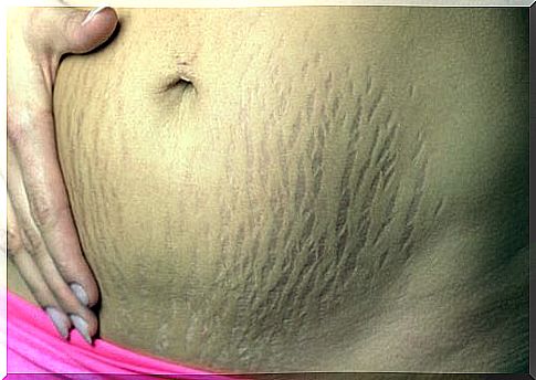 Stretch Marks After Pregnancy