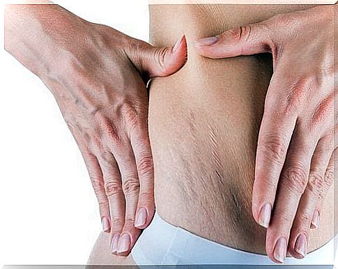 the stretch marks after pregnancy