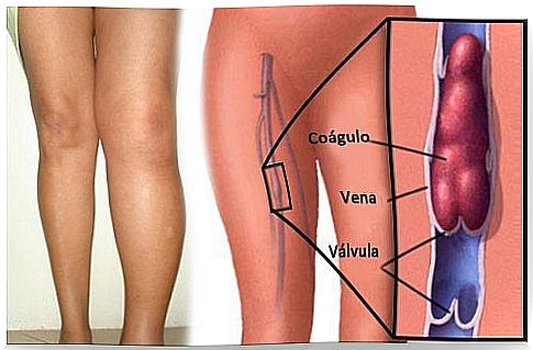 thrombosis and pregnancy