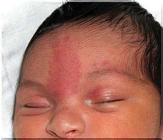 what causes birthmarks